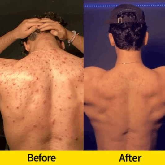 Glow Up with Lemon Turmeric Kojic Acid Soap: